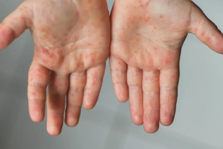 viruela-del-monojpeg